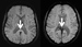 Image: The images show magnetic resonance (MR) slices through the brains of two mountaineers. The image on the left is from a mountaineer who climbed to altitudes above 7,000 meters, and the one on the right is from a mountaineer who survived a high altitude cerebral edema (HACE). The arrows point to the corpus callosum. This part of the corpus callosum is normal in the left image, whereas in the right image (HACE survivor) it shows black spots representing multiple small hemorrhages (microhemorrhages) (Photo courtesy of RSNA/Dr. Knauth et al, University Hospital Gottingen). Image: The images show magnetic resonance (MR) slices through the brains of two mountaineers. The image on the left is from a mountaineer who climbed to altitudes above 7,000 meters, and the one on the right is from a mountaineer who survived a high altitude cerebral edema (HACE). The arrows point to the corpus callosum. This part of the corpus callosum is normal in the left image, whereas in the right image (HACE survivor) it shows black spots representing multiple small hemorrhages (microhemorrhages) (Photo courtesy of RSNA/Dr. Knauth et al, University Hospital Gottingen).